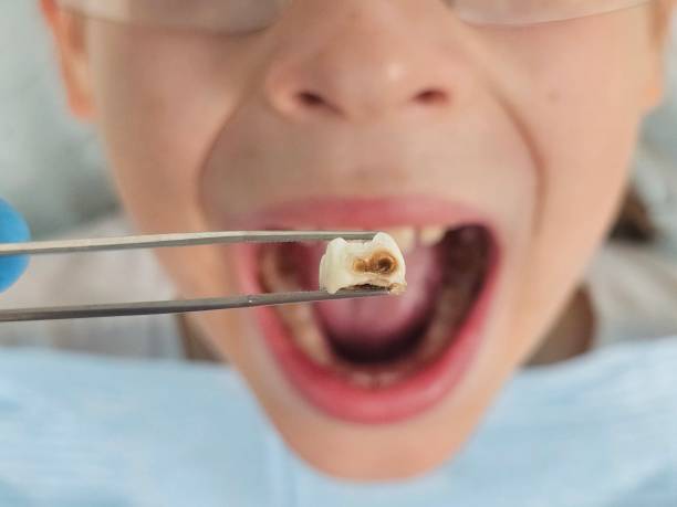 Best Emergency Wisdom Tooth Extraction in Denair, CA